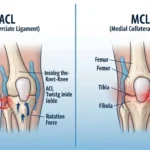 Difference Between ACL and MCL